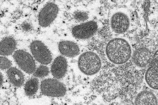 OMS evaluará si viruela del mono es considerada alerta sanitaria máxima