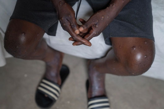 Reportan en Suecia primer caso de mpox fuera de África