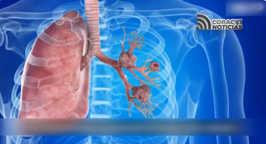 El Cáncer de pulmón es la segunda enfermedad más frecuente en México