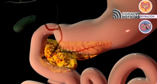 En México, el tercer cáncer más común es el de colon