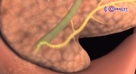 ¿Conoce qué es el cáncer de páncreas?