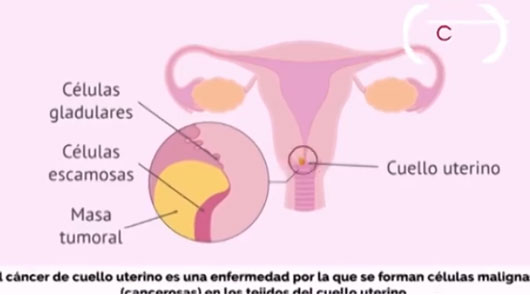 Detección oportuna del cáncer cervicouterino es clave para salvar vidas