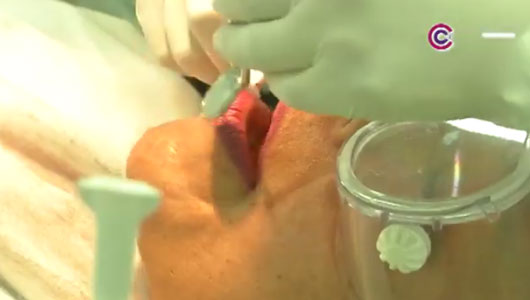 Caries, principal problema bucodental en Tlaxcala