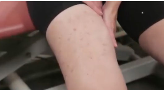 Conozca algunas causas y síntomas del linfedema