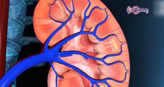 Mantiene Tlaxcala alta prevalencia de casos de enfermedad renal crónica